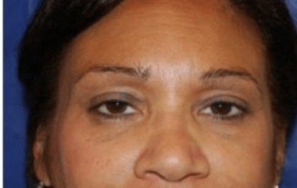 Blepharoplasty Before & After Patient #389