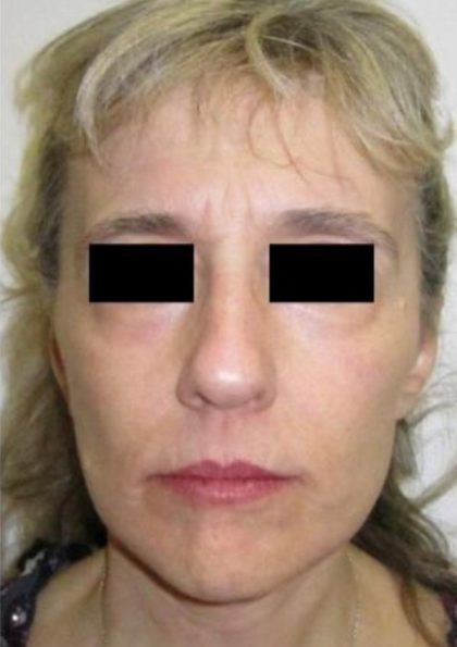 Facelift Before & After Patient #573