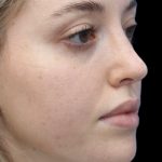 Primary Rhinoplasty Before & After Patient #857