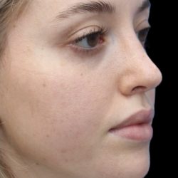 Primary Rhinoplasty Before & After Patient #857