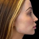 Dermal Fillers Before & After Patient #954
