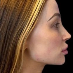 Dermal Fillers Before & After Patient #954