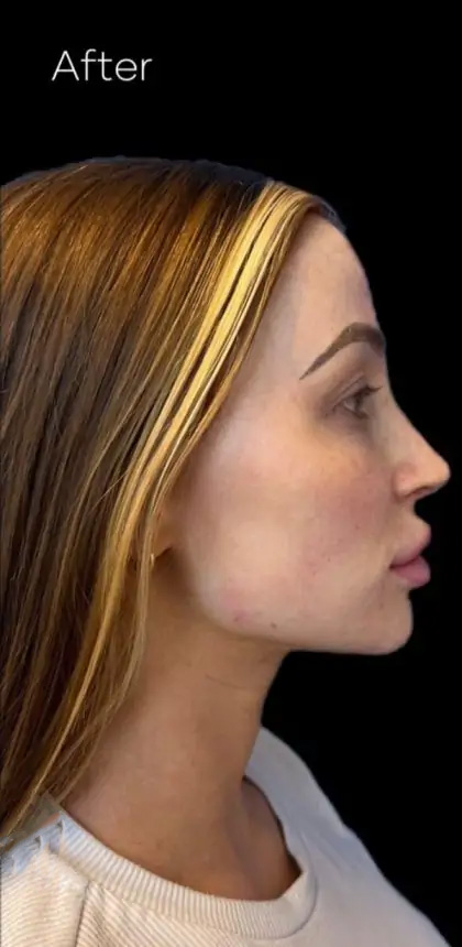 Dermal Fillers Before & After Patient #954