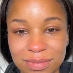 Dermal Fillers Before & After Patient #955