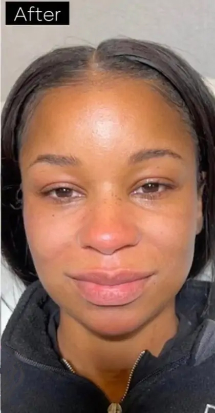 Dermal Fillers Before & After Patient #955