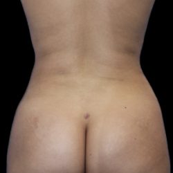 Brazilian Butt Lift Before & After Patient #403