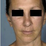Facelift Before & After Patient #574