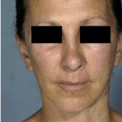 Facelift Before & After Patient #574