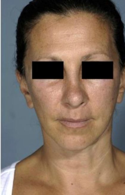 Facelift Before & After Patient #574