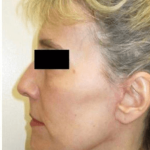 Neck Lift Before & After Patient #631