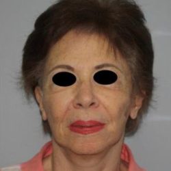 Facelift Before & After Patient #575