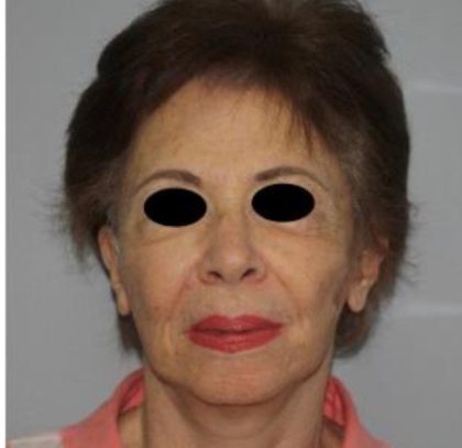 Facelift Before & After Patient #575