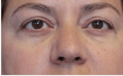 Blepharoplasty Before & After Patient #387
