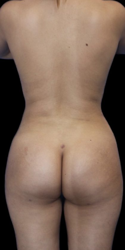 Brazilian Butt Lift Before & After Patient #403