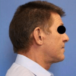 Neck Lift Before & After Patient #632