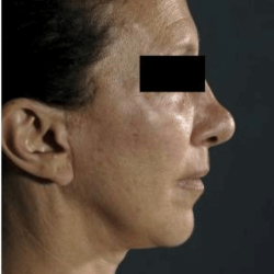 Neck Lift Before & After Patient #633