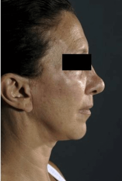 Neck Lift Before & After Patient #633
