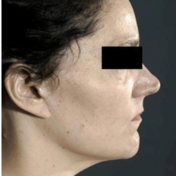 Neck Lift Before & After Patient #634