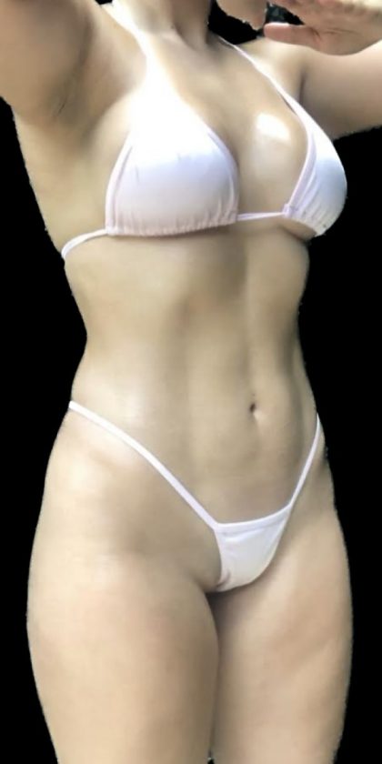 Liposuction/Liposculpture Before & After Patient #599