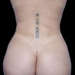 Liposuction/Liposculpture Before & After Patient #600