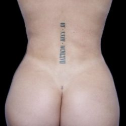 Liposuction/Liposculpture Before & After Patient #600