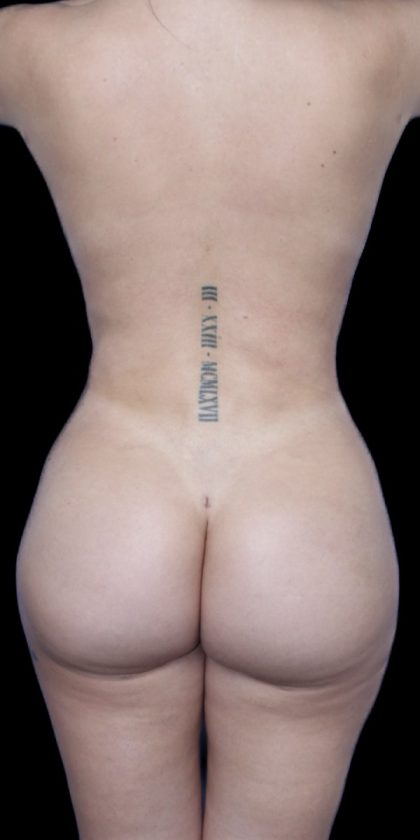 Liposuction/Liposculpture Before & After Patient #600