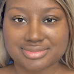 Primary Rhinoplasty Before & After Patient #823