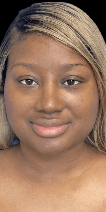 Primary Rhinoplasty Before & After Patient #823