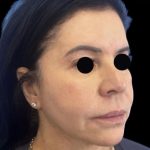 Morpheus8 Before & After Patient #1039