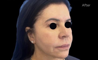 Morpheus8 Before & After Patient #1039