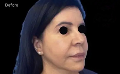 Morpheus8 Before & After Patient #1039