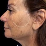 Morpheus8 Before & After Patient #1038