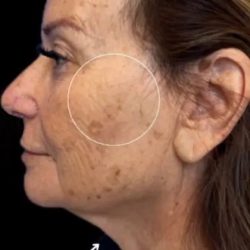 Morpheus8 Before & After Patient #1038