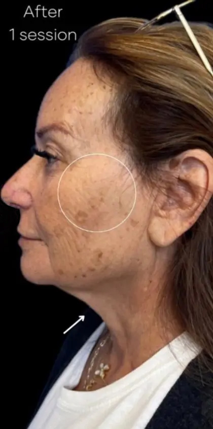 Morpheus8 Before & After Patient #1038