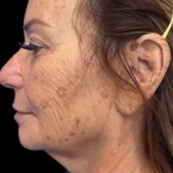 Morpheus8 Before & After Patient #1038