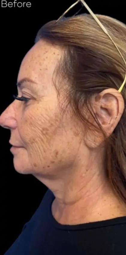 Morpheus8 Before & After Patient #1038