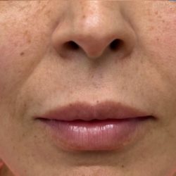 PDO Thread Lift Before & After Patient #1036