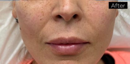 PDO Thread Lift Before & After Patient #1036