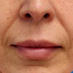 PDO Thread Lift Before & After Patient #1036