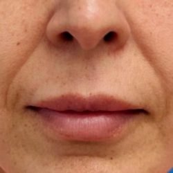 PDO Thread Lift Before & After Patient #1036
