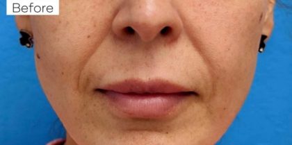 PDO Thread Lift Before & After Patient #1036