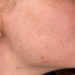Platelet Rich Plasma (PRP) Before & After Patient #1037