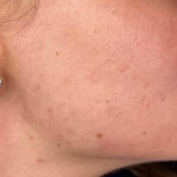 Platelet Rich Plasma (PRP) Before & After Patient #1037