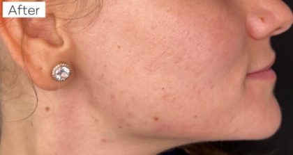 Platelet Rich Plasma (PRP) Before & After Patient #1037