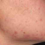 Platelet Rich Plasma (PRP) Before & After Patient #1037