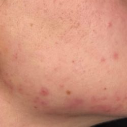 Platelet Rich Plasma (PRP) Before & After Patient #1037