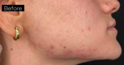Platelet Rich Plasma (PRP) Before & After Patient #1037