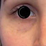 Platelet Rich Plasma (PRP) Before & After Patient #1040