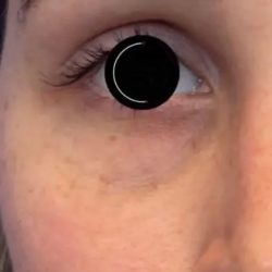 Platelet Rich Plasma (PRP) Before & After Patient #1040