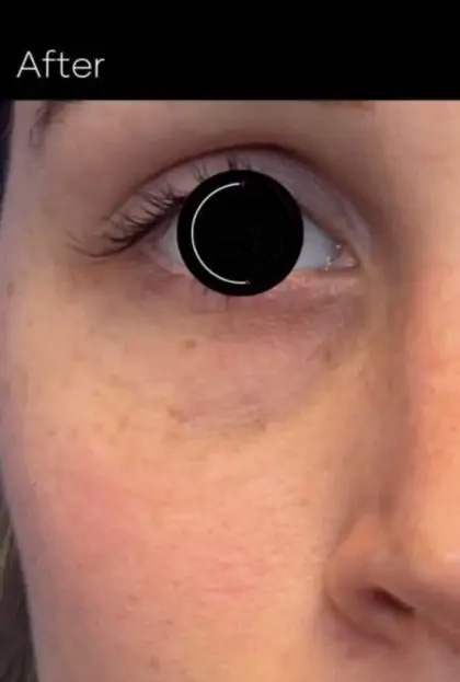 Platelet Rich Plasma (PRP) Before & After Patient #1040